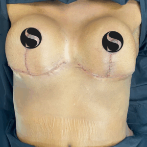 Breast Lift with Implants – 02063