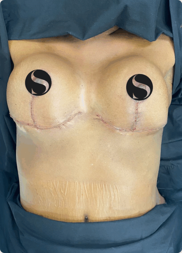 Breast Lift with Implants - 02063 - Image 2