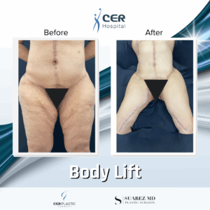 Body Lift – 05063