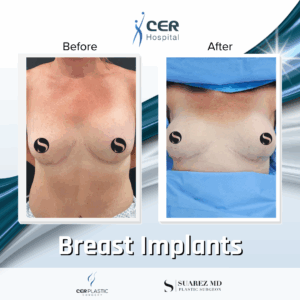 Breast Implant – 05063