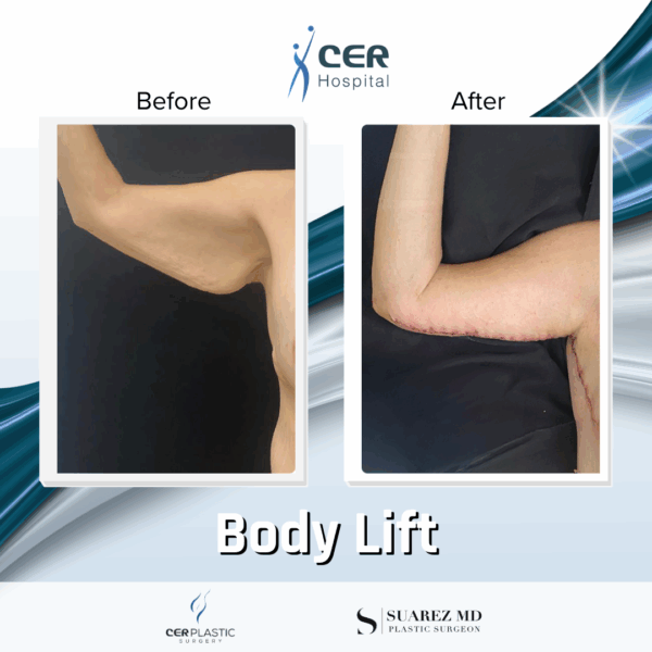 Body Lift - 12063 - Image 5
