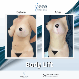 Body Lift – 30063
