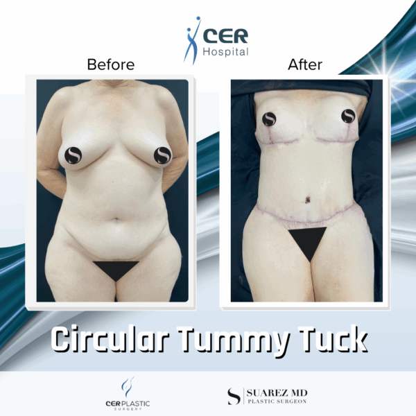 Circular Tummy Tuck - 05073 - Image 5