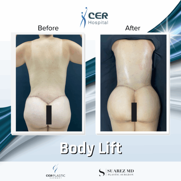 Body Lift - 14073 - Image 5