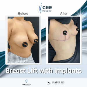 Breast Lift with Implants – 30063