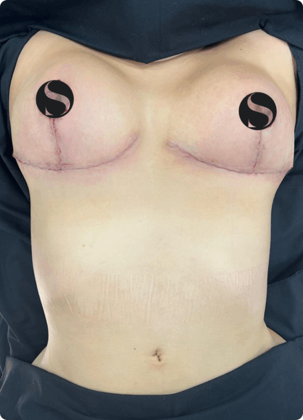 Breast Lift with Implants - 30063 - Image 3