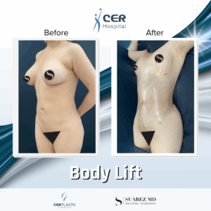 Body Lift – 30053