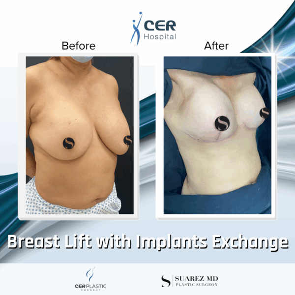 Breast Lift with Implant Exchange - 09063 - Image 5