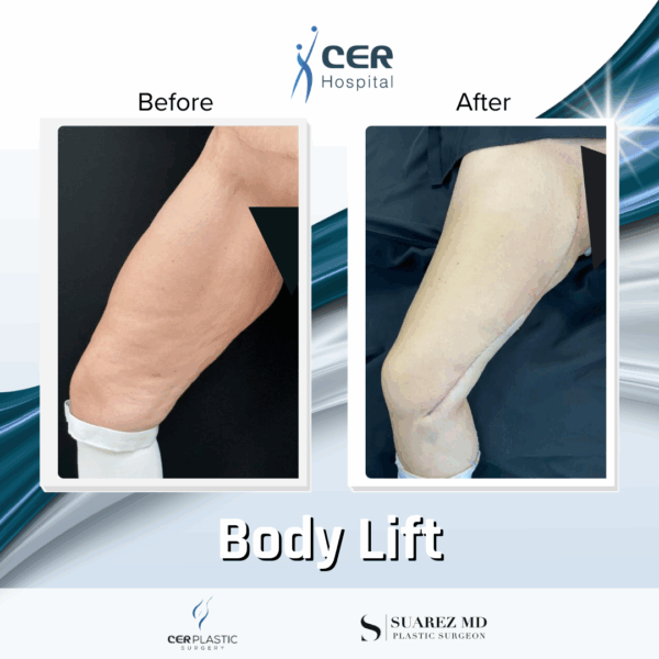 Body Lift - 039 - Image 4