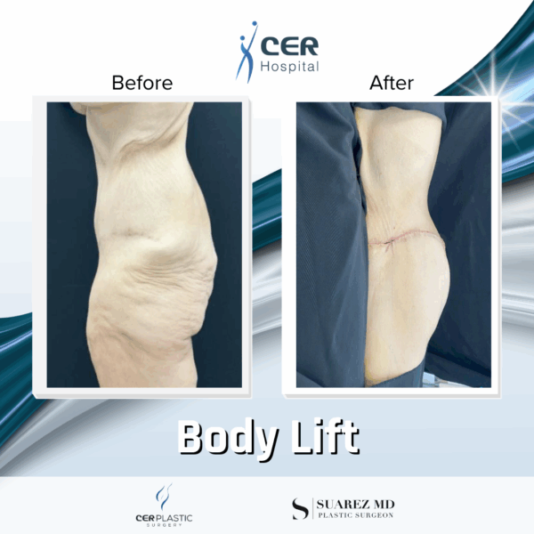 Body Lift - 019 - Image 5