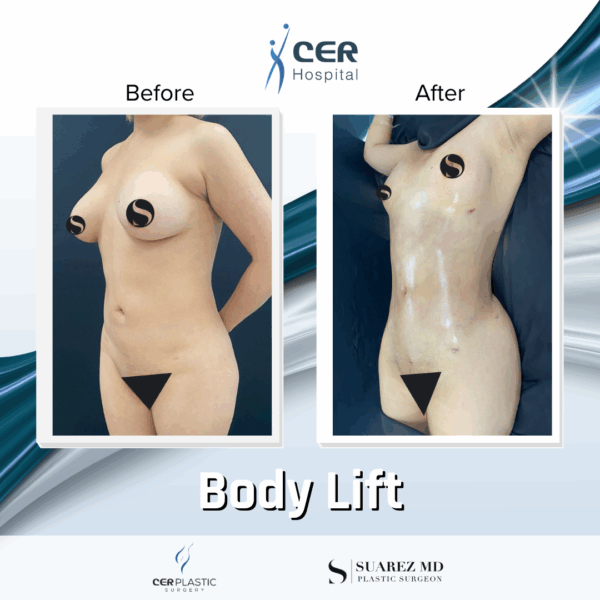 Body Lift - 30053