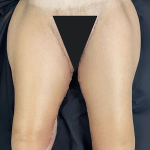 Extended Thigh Lift – 06113