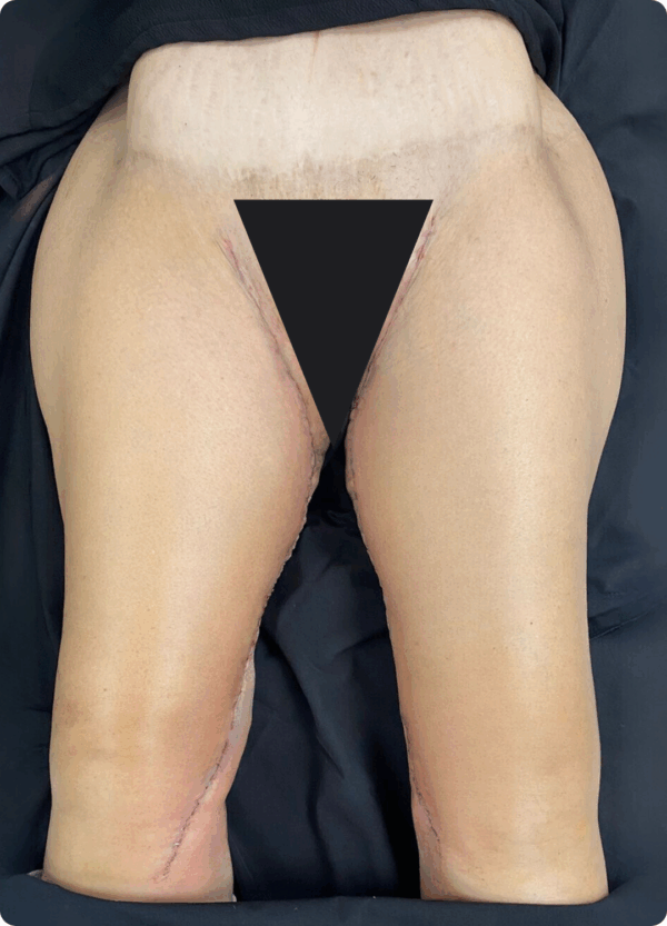Extended Thigh Lift - 06113 - Image 2
