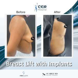 Breast Lift with Implants – 02063