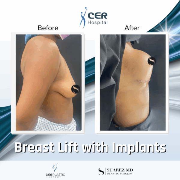 Breast Lift with Implants - 02063 - Image 4