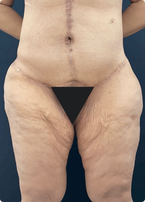 Body Lift - 05063 - Image 3