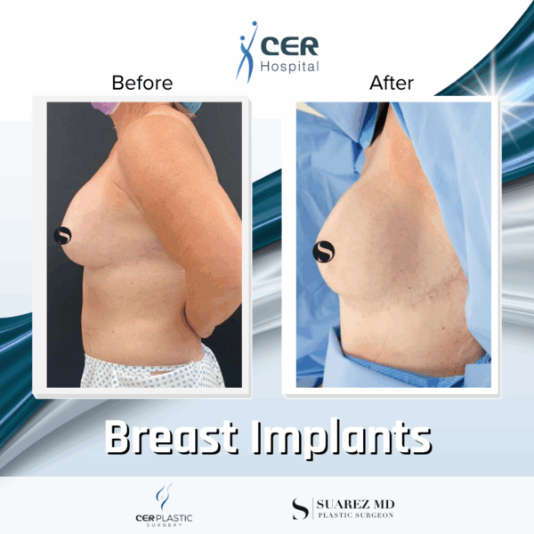 Breast Implant - 05063 - Image 5