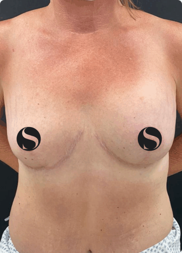 Breast Implant - 05063 - Image 3