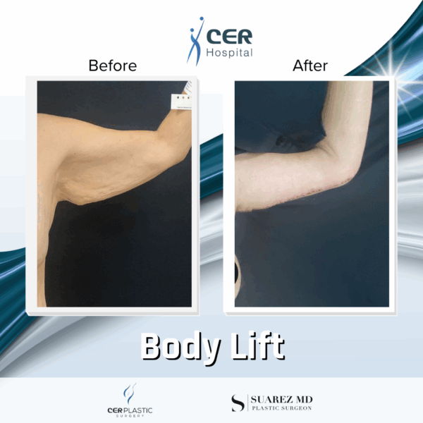 Body Lift - 12063 - Image 6