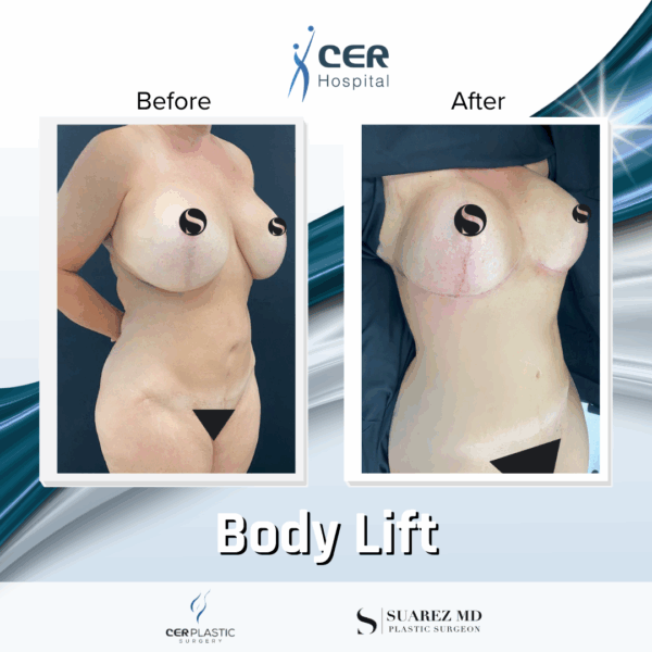 Body Lift - 30063 - Image 5