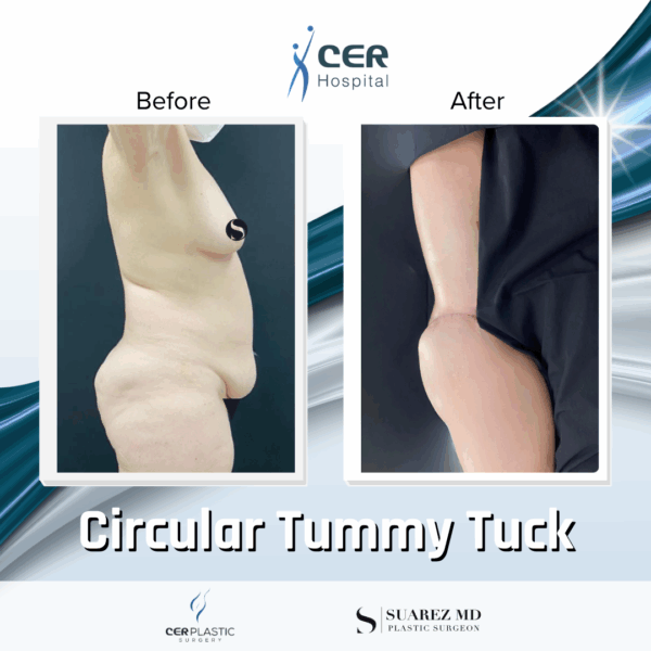 Circular Tummy Tuck - 05073 - Image 6