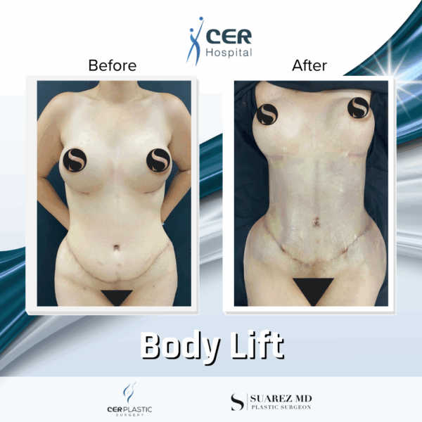 Body Lift - 14073 - Image 6