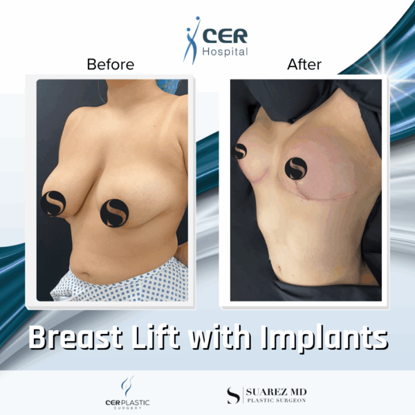 Breast Lift with Implants - 30063 - Image 5