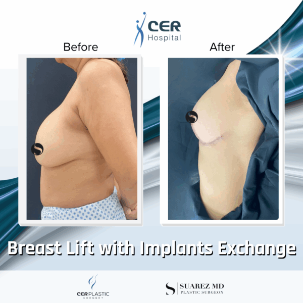 Breast Lift with Implant Exchange - 09063 - Image 6