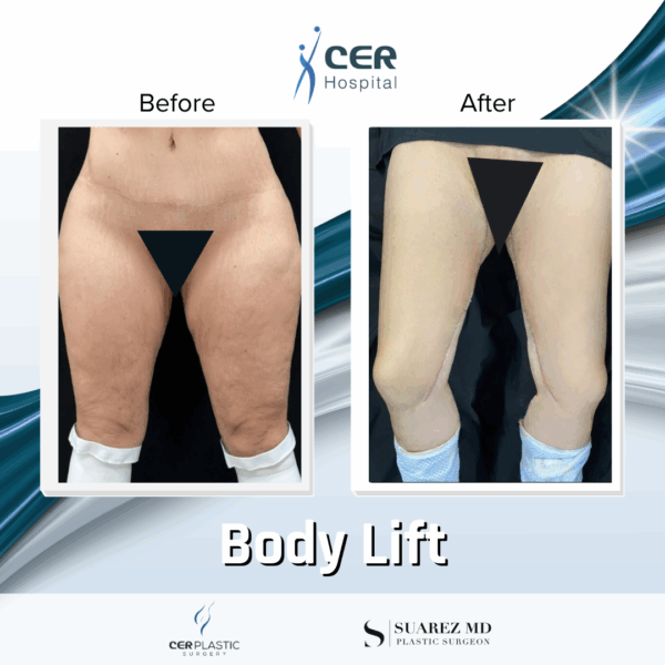 Body Lift - 039 - Image 5
