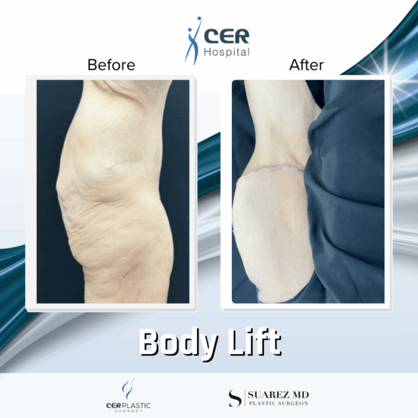 Body Lift - 019 - Image 6