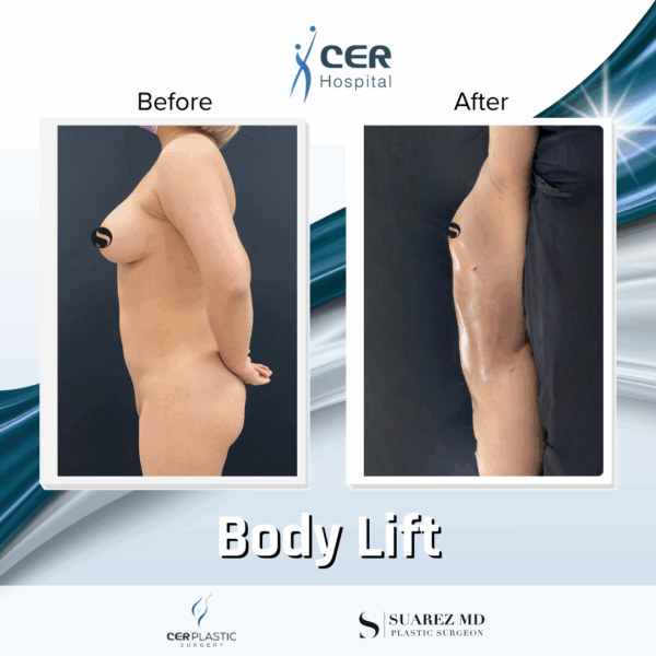Body Lift - 30053 - Image 5