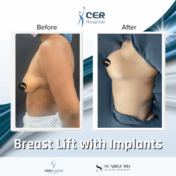 Breast Lift with Implants - 02063 - Image 5