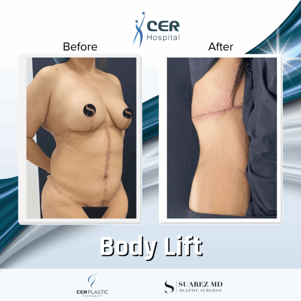Body Lift - 05063 - Image 5