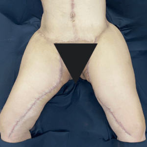 Body Lift – 05063