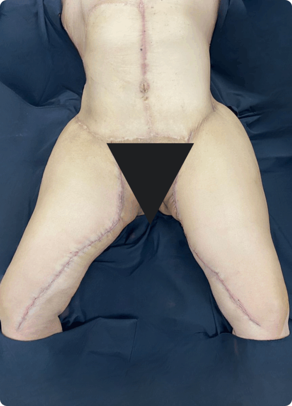 Body Lift - 05063 - Image 2
