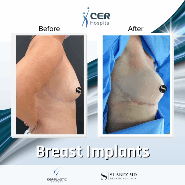 Breast Implant - 05063 - Image 6