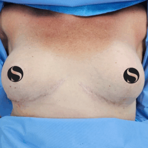 Breast Implant – 05063
