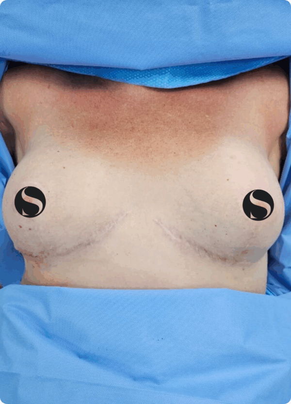 Breast Implant - 05063 - Image 2