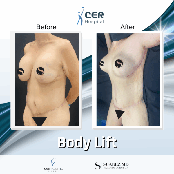 Body Lift - 12063 - Image 7