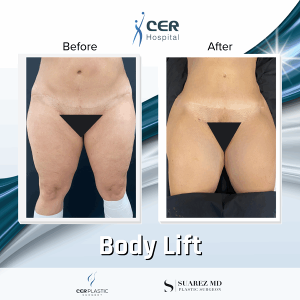 Body Lift - 30063 - Image 6