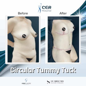 Circular Tummy Tuck – 05073