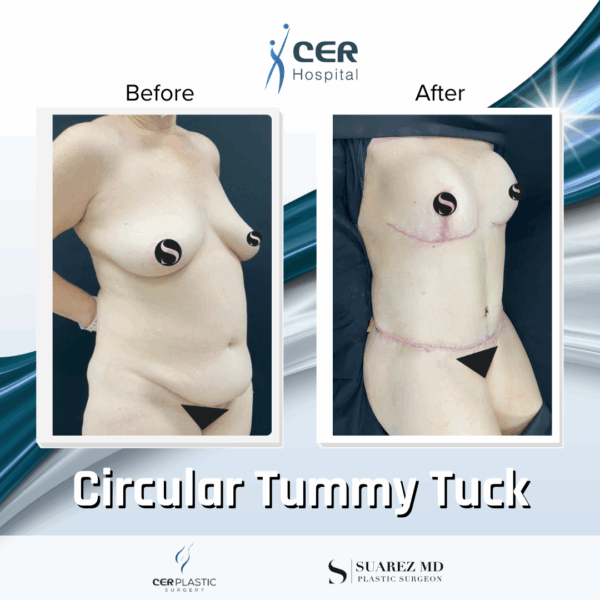 Circular Tummy Tuck - 05073