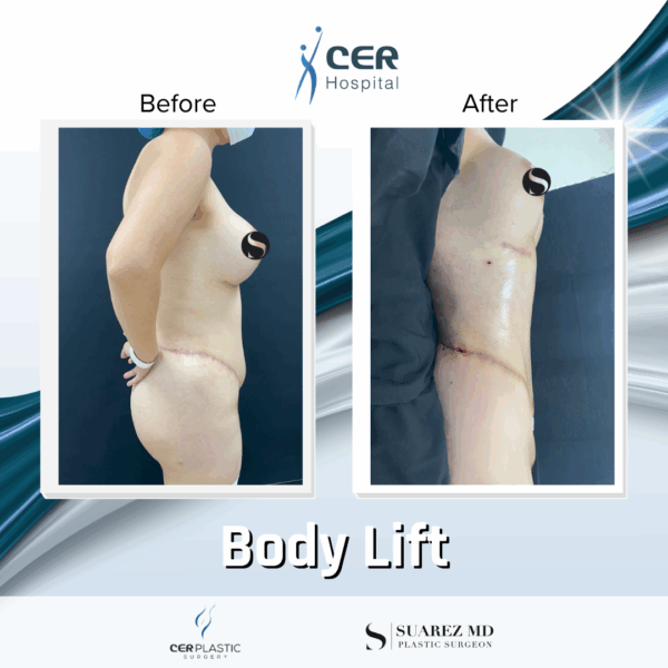 Body Lift - 14073 - Image 7