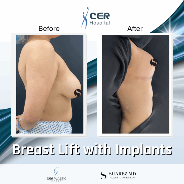 Breast Lift with Implants - 30063 - Image 6