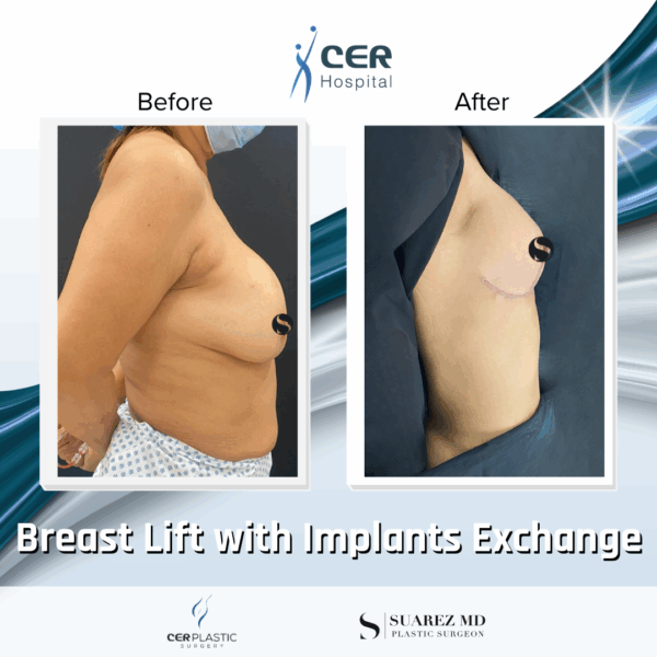 Breast Lift with Implant Exchange - 09063 - Image 7