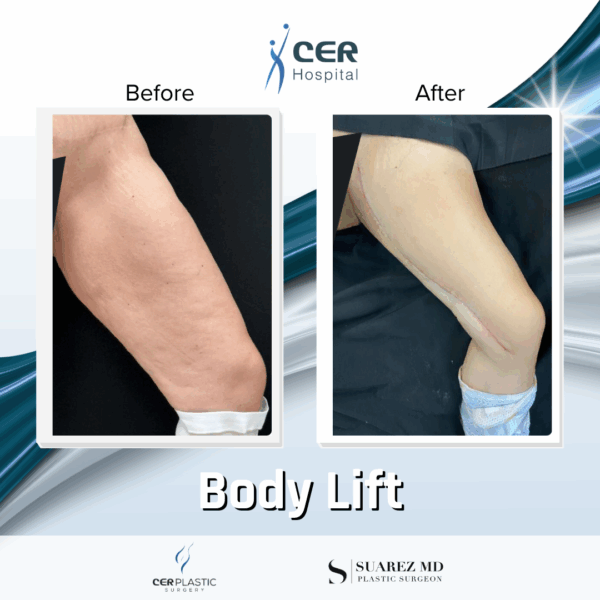 Body Lift - 039 - Image 6