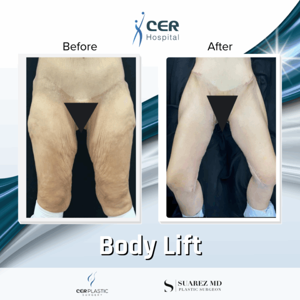 Body Lift - 019
