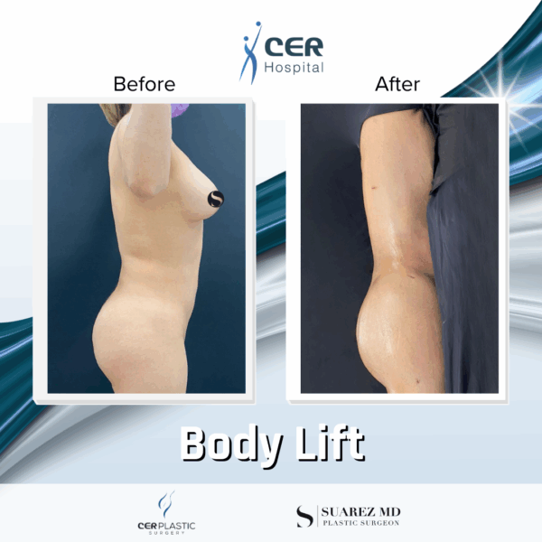 Body Lift - 30053 - Image 6
