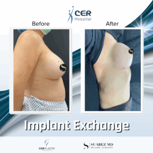 Implant Exchange – 09063