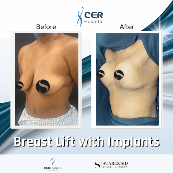 Breast Lift with Implants - 02063 - Image 6